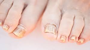 Nail Infection Is Inherited Nail Infection Causes